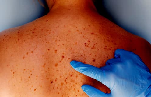 Skin Cancer Misdiagnosis