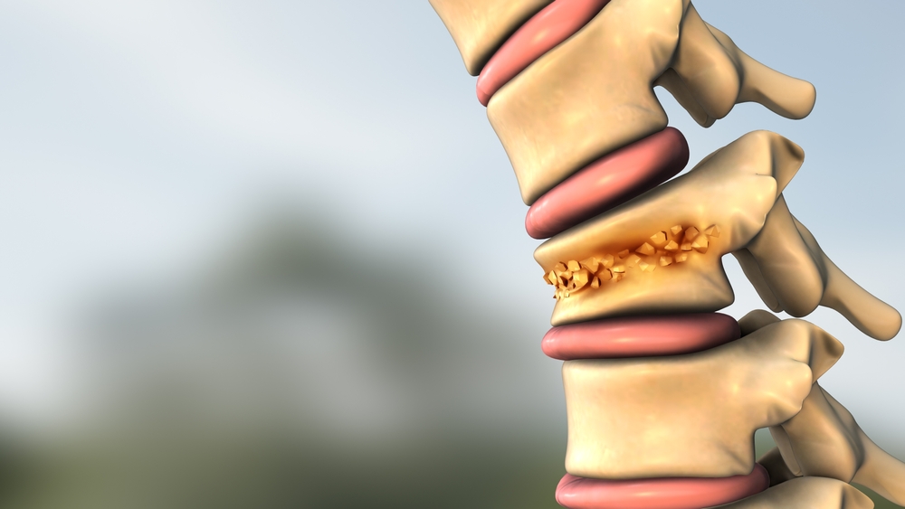 Spinal Damage
